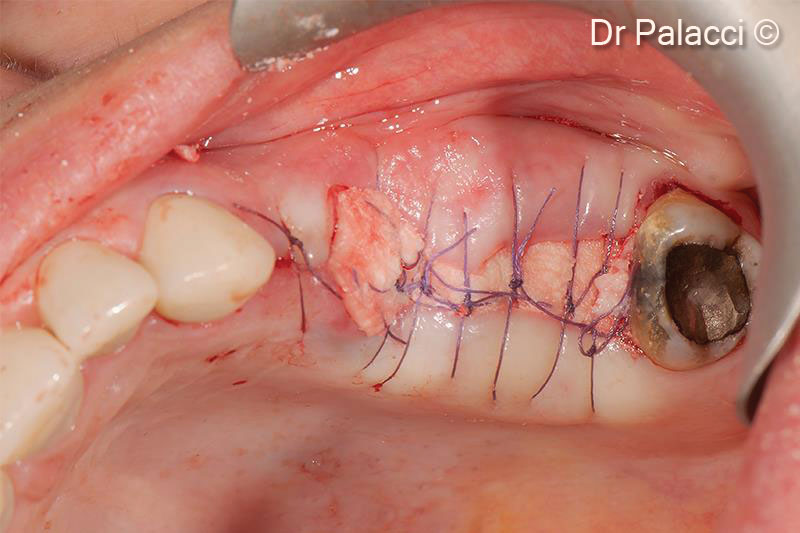 6. A collagen membrane covers the defect filled with the biomaterial
