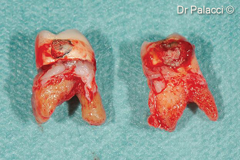 4. Teeth are extracted, all labial bone is lost. Major bone loss is visible