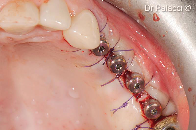 17. Soft tissue manipulation around implants