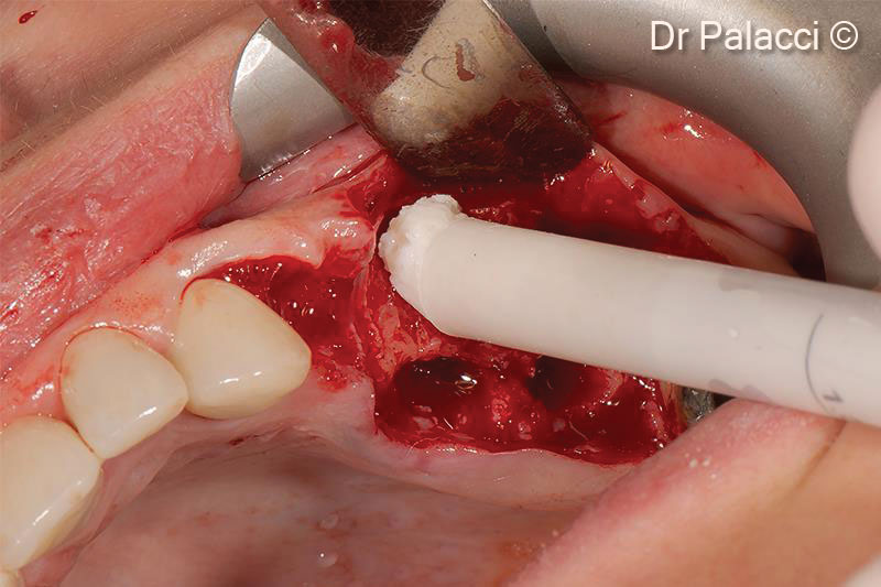 Advanced periodontal disease associated...