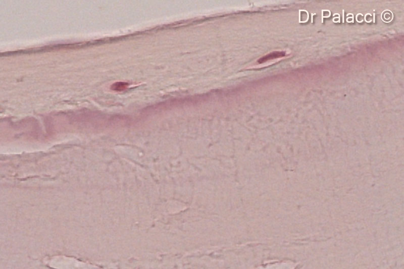 14. Part of biopsies retrieved 4 months after augmentation with GTO®. The particles of biomaterial are surrounded by newly formed bone, presence of osteocyte lacunae