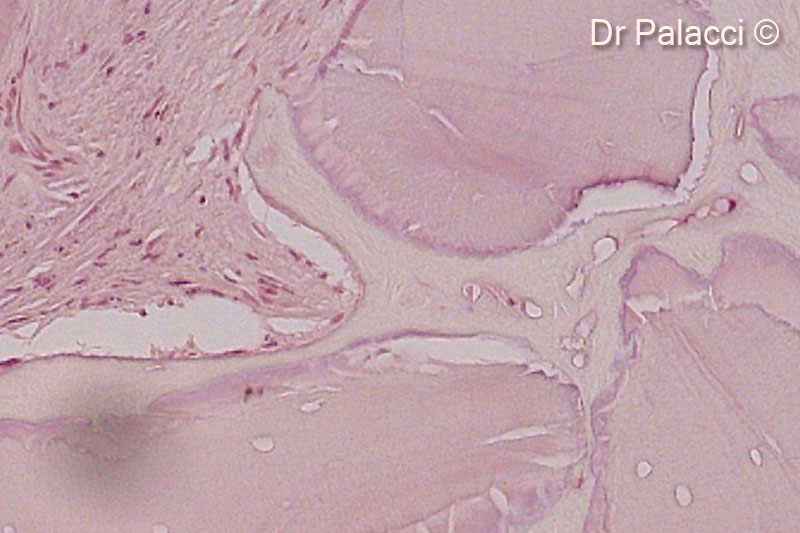 12. Part of biopsies retrieved 4 months after augmentation with GTO®. The particles of biomaterial are surrounded by newly formed bone, presence of osteocyte lacunae