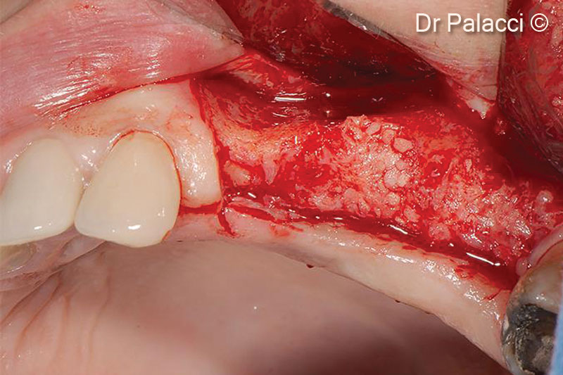 8. Note the optimal hard tissue volume obtained and the quality of the bone formation