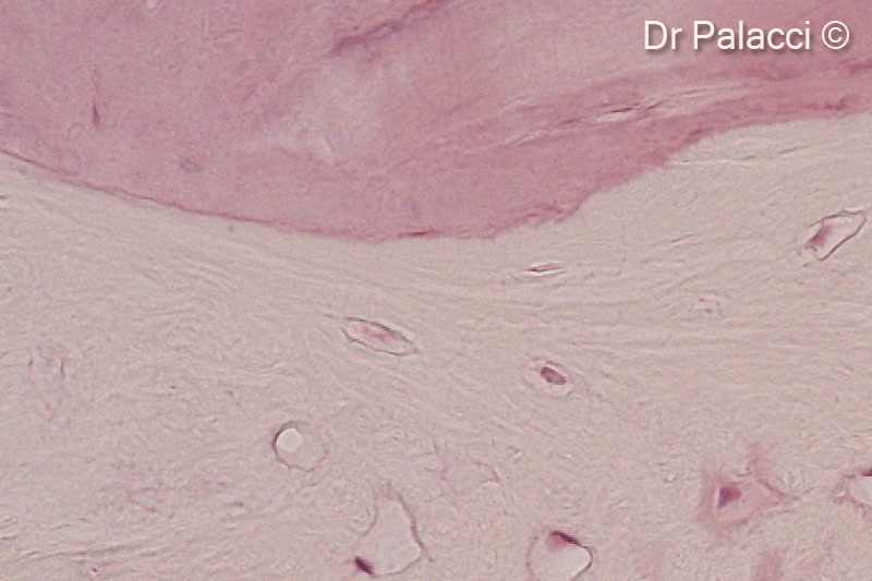 13. Part of biopsies retrieved 4 months after augmentation with GTO®. The particles of biomaterial are surrounded by newly formed bone, presence of osteocyte lacunae