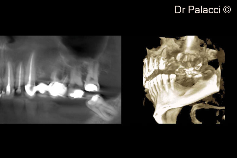 2.  3D X-rays, major bone loss around #26, #27, #28 furcation involvement. Significant concavity in #24
