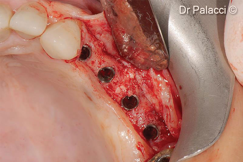 16. Re-entry 4 months later. Implants are perfectly integrated into a well vascularized bone