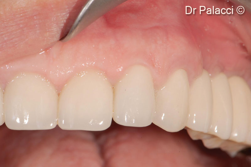 20. Final reconstruction in place (Prosthodontist Dr Christian Roux, Marseille)