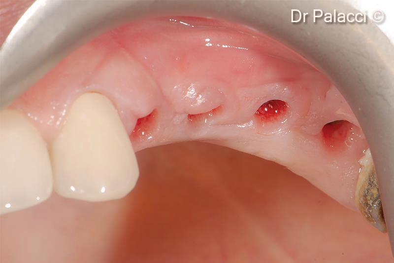18.  Healing after three weeks. Note the ridge augmentation as well as shape, colour, texture of soft tissue