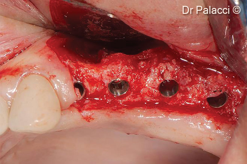 9.  Four implants of 3.5mm diameter are inserted