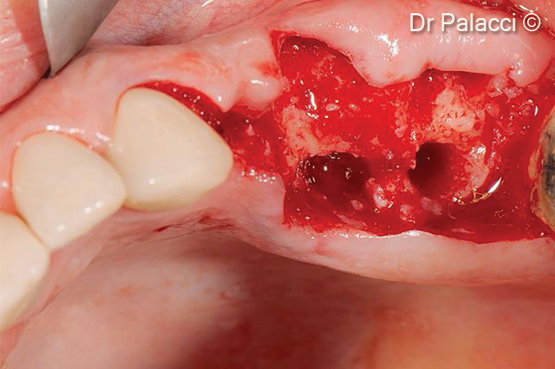 3. Teeth are extracted, all labial bone is lost. Major bone loss is visible