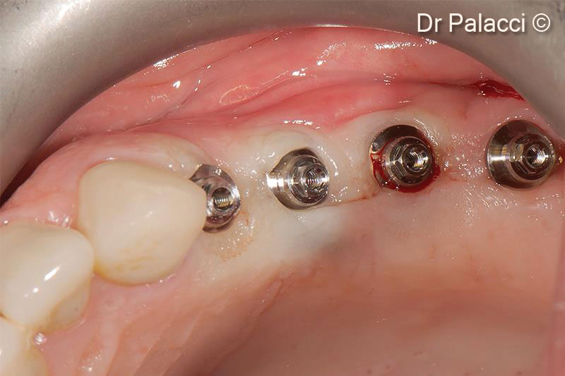 19. Abutments are selected and placed for a screw retained restauration