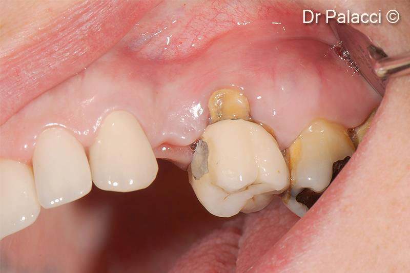 1. Loss of #24, #26, #27 and #28, have to be extracted