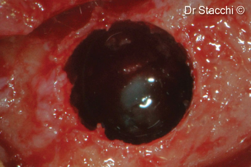 3. Maxillary sinus floor was interrupted, showing intact Schneiderian membrane