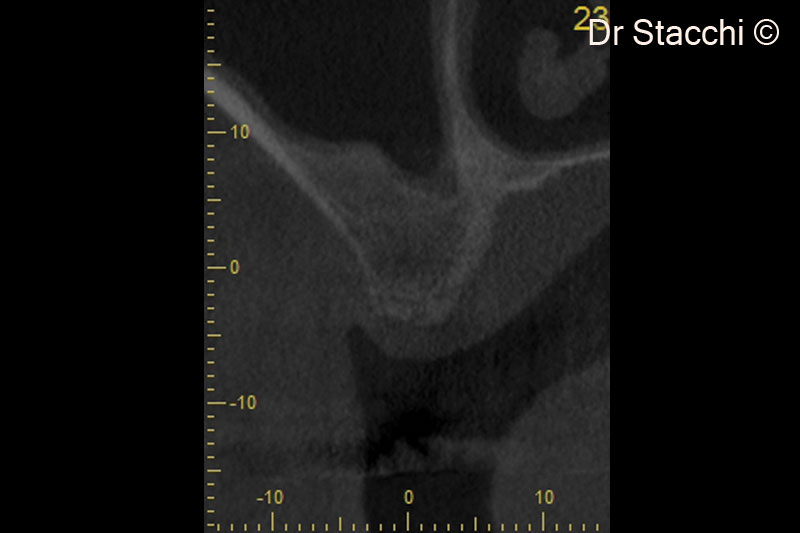 9. CBCT scan taken six months after surgery. Schneiderian membrane appears healthy