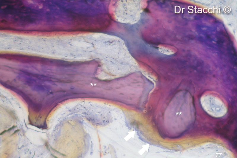 15. Residual biomaterial particles appeared surrounded and joined together by newly-formed bone (magnification 200×). Toluidine blue and pironine G stain (courtesy Prof. Tonino Traini). Histomorphometric analysis showed 25.4% newly-formed bone, 19.9% residual graft particles and 54.7% marrow spaces