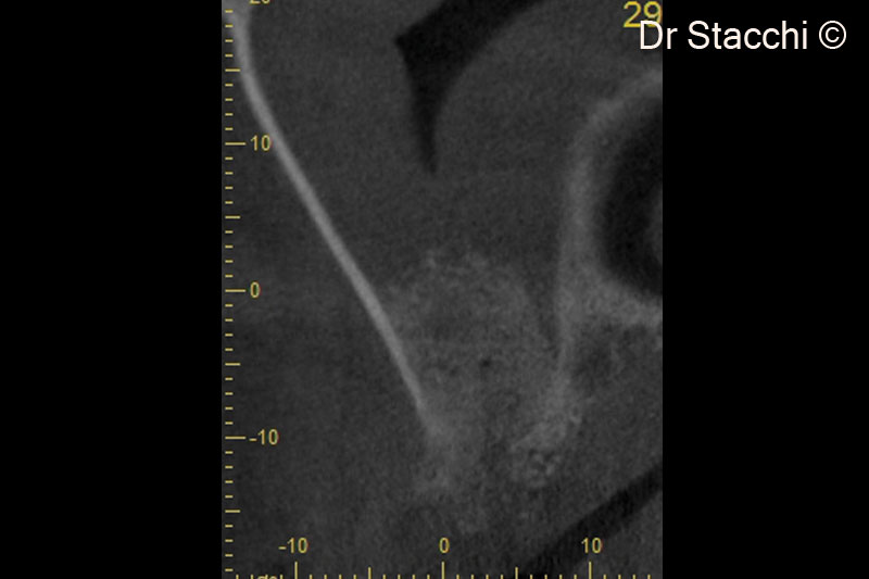 8. CBCT scan taken one week after surgery shows good contact of the grafting material with lateral and medial sinus walls. Schneiderian membrane is hypertrophic due to the surgical trauma