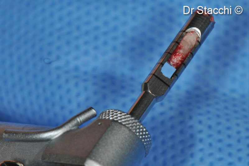 12. Bone-core biopsy of the grafted area was harvested by using 3mm diameter trephine drill