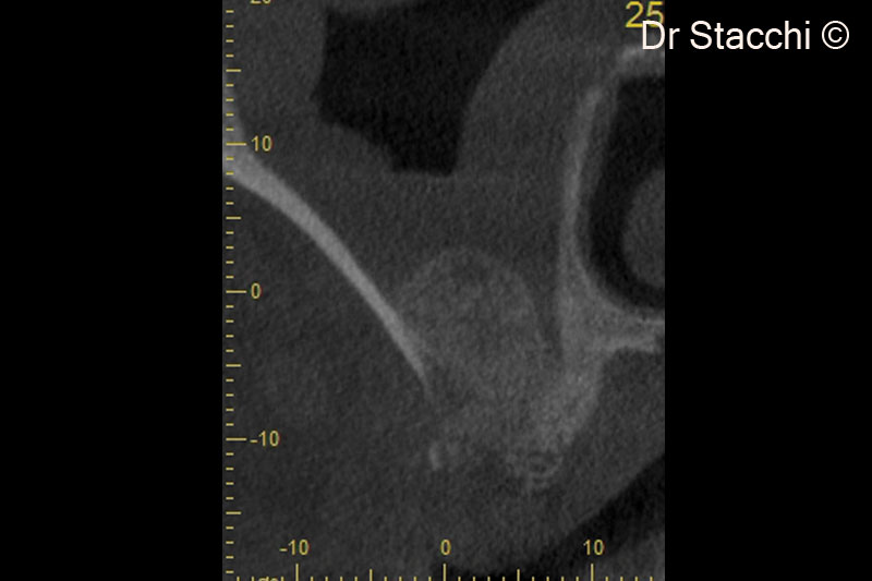 6. CBCT scan taken one week after surgery shows good contact of the grafting material with lateral and medial sinus walls. Schneiderian membrane is hypertrophic due to the surgical trauma