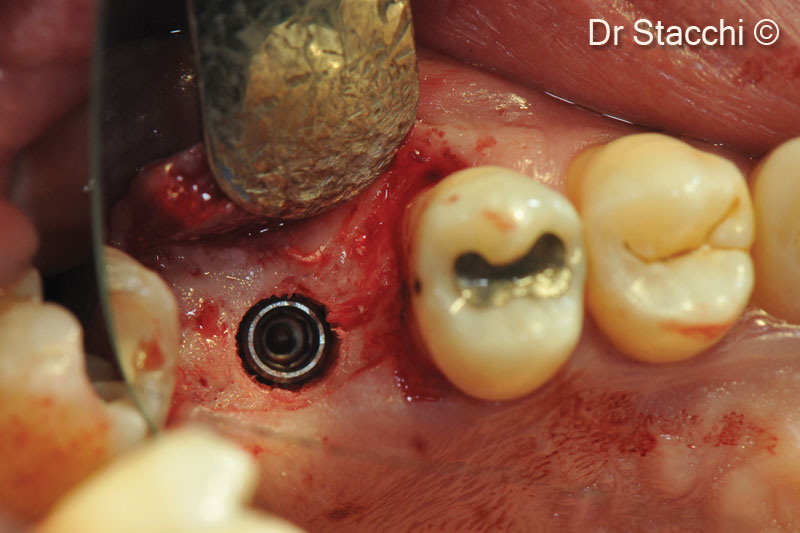 14. A dental implant (4.0x10mm) was inserted in the biopsy site