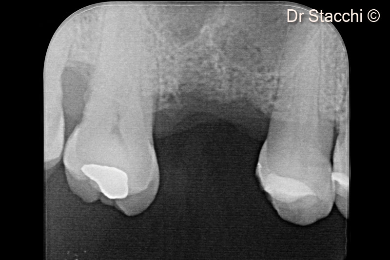 1. Pre-operative X-ray, showing 2.5 mm residual bone height and the presence of an Underwood septum