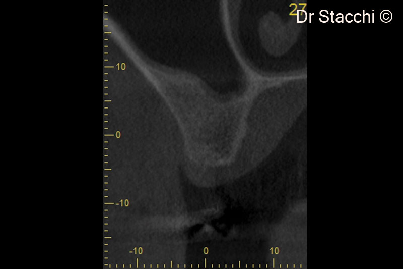 11. CBCT scan taken six months after surgery. Schneiderian membrane appears healthy