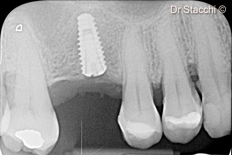 13. A dental implant (4.0x10mm) was inserted in the biopsy site