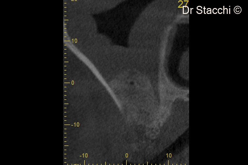 7. CBCT scan taken one week after surgery shows good contact of the grafting material with lateral and medial sinus walls. Schneiderian membrane is hypertrophic due to the surgical trauma