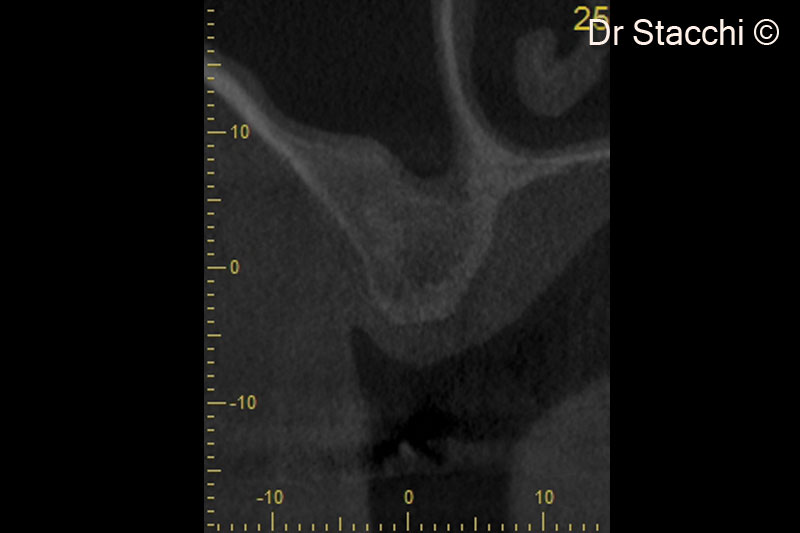 10. CBCT scan taken six months after surgery. Schneiderian membrane appears healthy