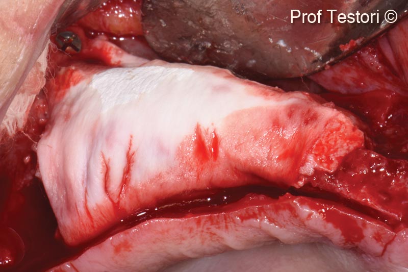 10.  Horizontal augmentation with OsteoBiol GTO<sup>®</sup>