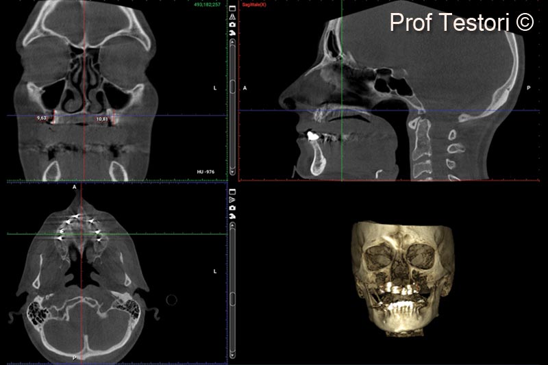 14. 10-months follow-up CBCT before implant uncovering
