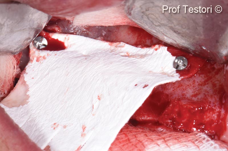 8. Collagen membrane Evolution is fixed with microscrews