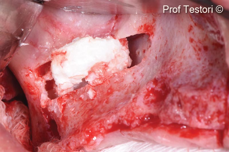 6. Grafting phase with sticky heterologous bone in a collagen matrix OsteoBiol GTO<sup>®</sup>