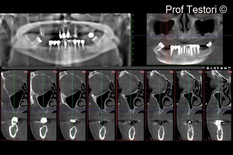 1. Pre-operative panorex and CBCT
