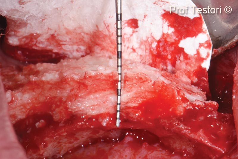 9. Horizontal augmentation with OsteoBiol GTO<sup>®</sup>