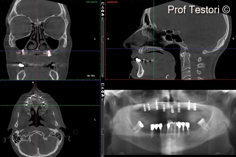 15. 10-months follow-up CBCT before implant uncovering