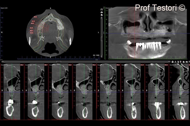 11.  Immediate post-op panorex after healing and CBCT
