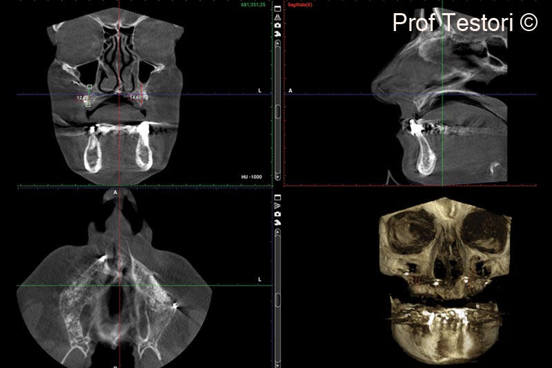 12.  6-months follow-up CBCT performed before implant placement