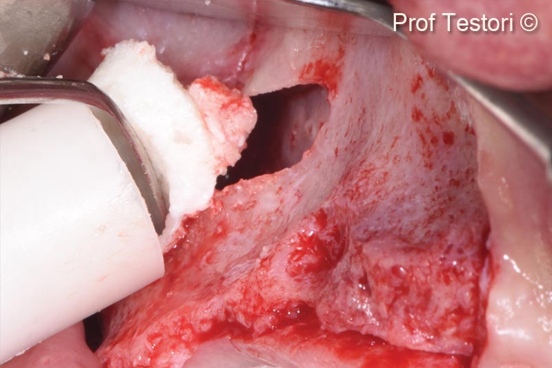 Bilateral maxillary sinus elevation...