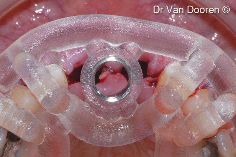 11. Placement of the implant (V3/ RP 3,9 mm - 13 mm) using the MGuide (MIS). The palatal position for obtaining a screw retained restoration is the key point in this specific case