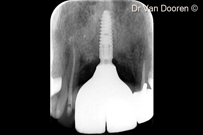 19. Final X-Ray. Note stable marginal bone levels around the implant and the nice integration of the graft (OsteoBiol® GTO®) in the peri-implant space