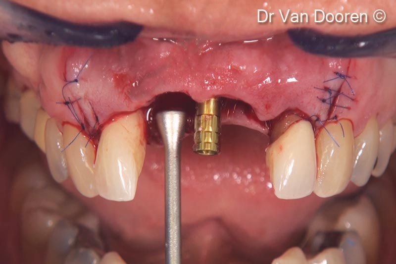 14. After placement of a provisional cylinder, OsteoBiol® GTO® was placed and packed, with the instruments and around the implant in order to support the soft tissue