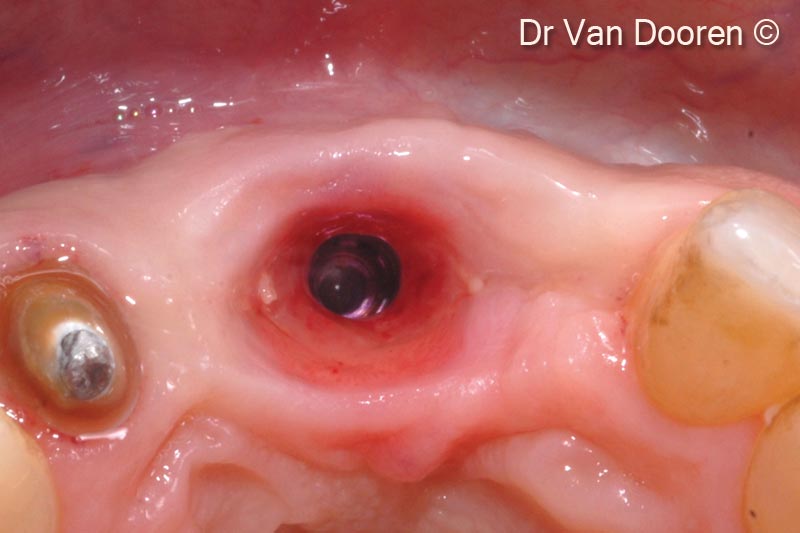 15. After making the final preparation of tooth #22, a digital impression was taken with a scanpost (MIS)
