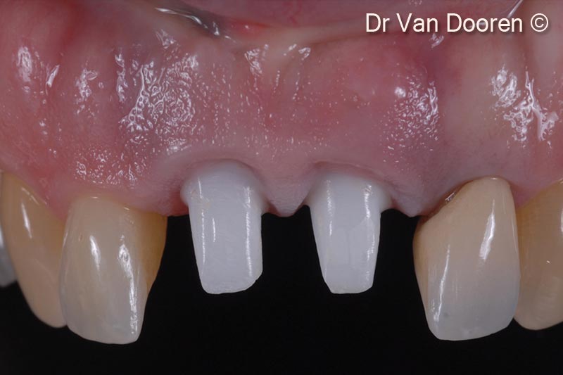 4. The old crowns were removed, and a provisional bridge was fabricated with a new design proposal. Pink composite was added to have a clear idea of the incisal edge position/toothform and artificial gingival replacement