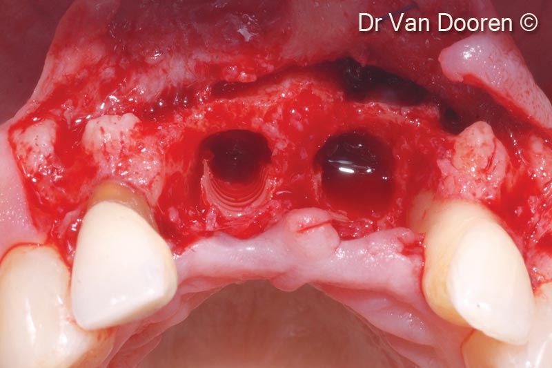 9. Considerable bone loss around the existing implants and mesially to the lateral incisors: the two implants were removed