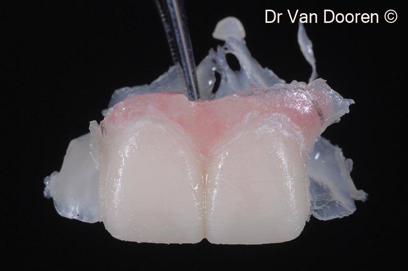 3. The old crowns were removed, and a provisional bridge was fabricated with a new design proposal. Pink composite was added to have a clear idea of the incisal edge position/toothform and artificial gingival replacement