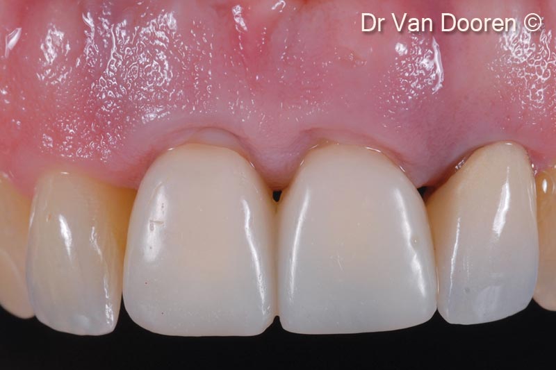 1. The patient presented with severe peri-implantitis around 2 central incisors zirconia implants