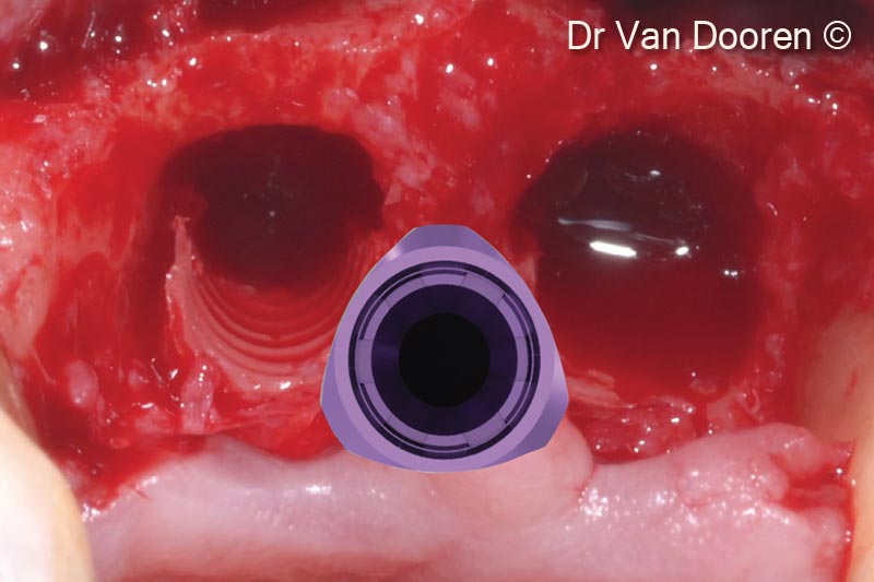 10. Occlusal view after implant removal: the ridge was surgically corrected and flattened after implant removal. The implant will be placed in a more palatal and “in between” position compared to the extraction sockets to get excellent primary stability for immediate loading