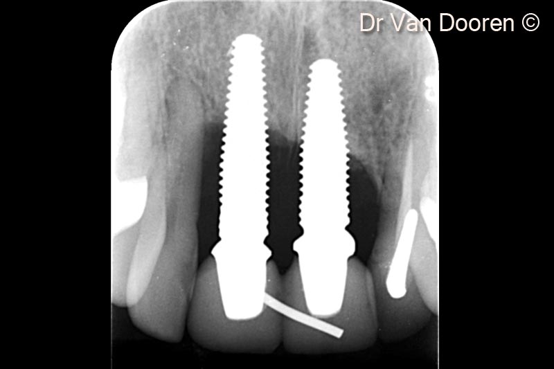 2. The patient presented with severe peri-implantitis around 2 central incisors zirconia implants