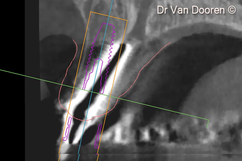 6. Superimposing the STL file and the Dicom files in the planning software (MSoft/MIS) allowed us to plan the exact position of the new implant
