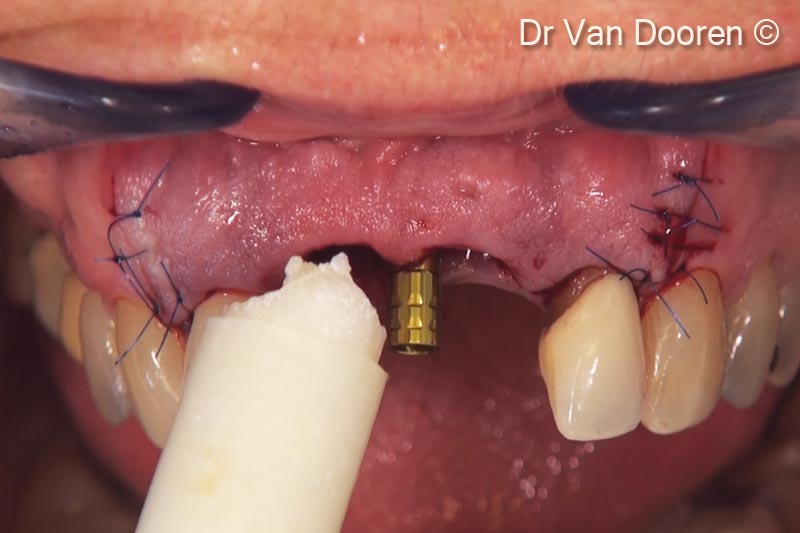 12.  After placement of a provisional cylinder, OsteoBiol® GTO® was placed and packed, with the instruments and around the implant in order to support the soft tissue